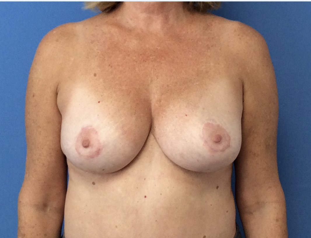 Breast-Lift-with-Minor-Breast-Reduction | After Breast Lift